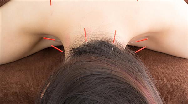 中醫(yī)針灸有何療效？石家莊炎黃針灸推拿學(xué)校為你分享！